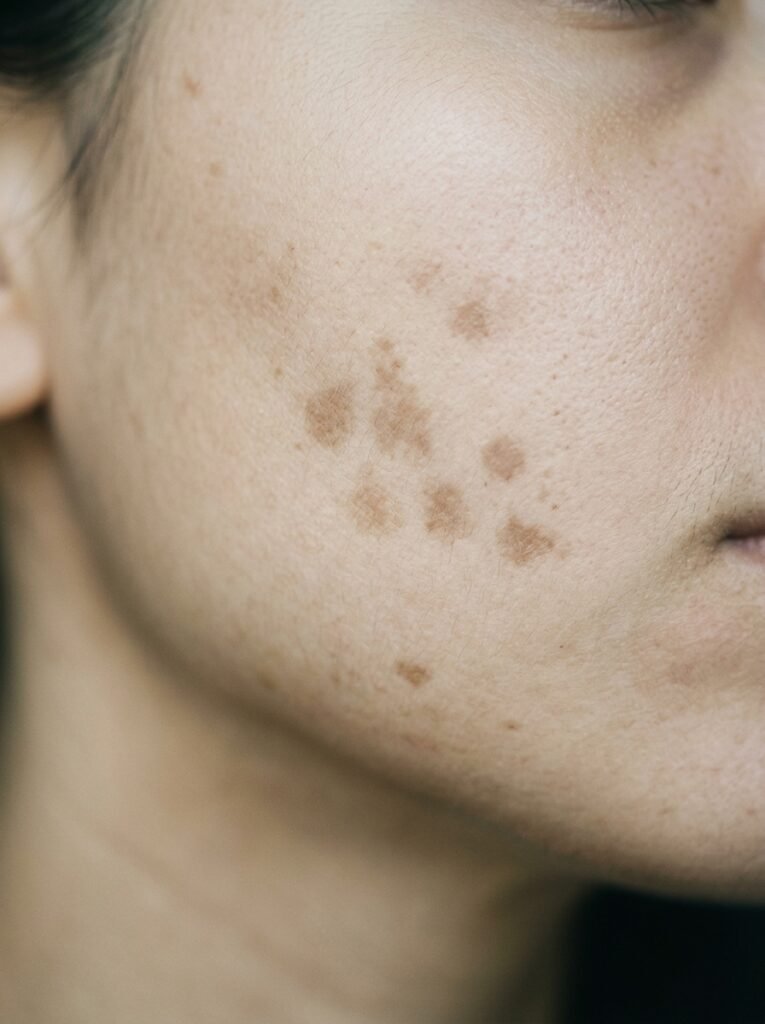Hyperpigmentation Treatment in 2026: Dermatologist Options 3 Macro view of skin marks 202608221647